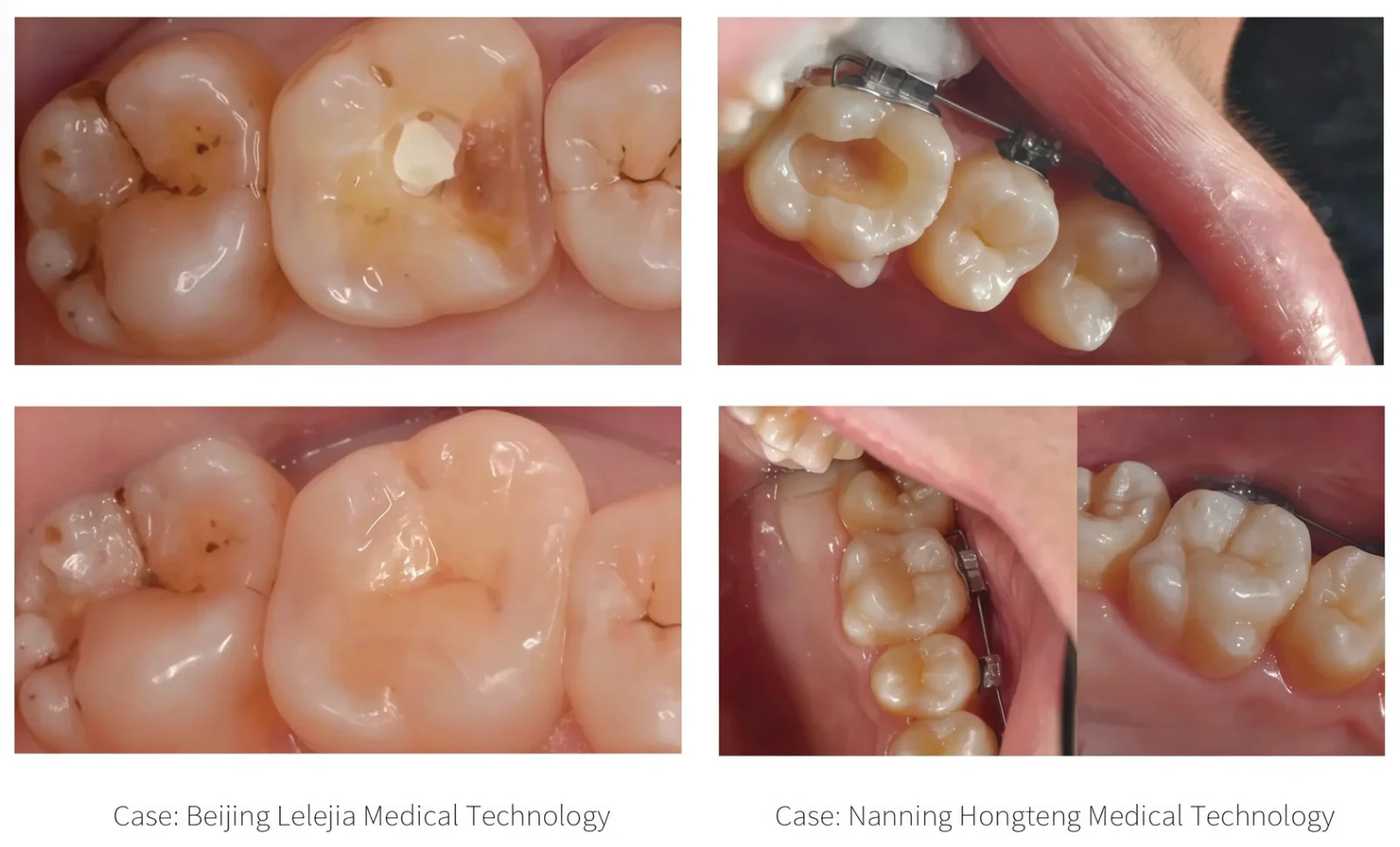 US Dental Lithium Disilicate Glass Ceramic Blocks CEREC Veneer Crown C14 CAD/CAM